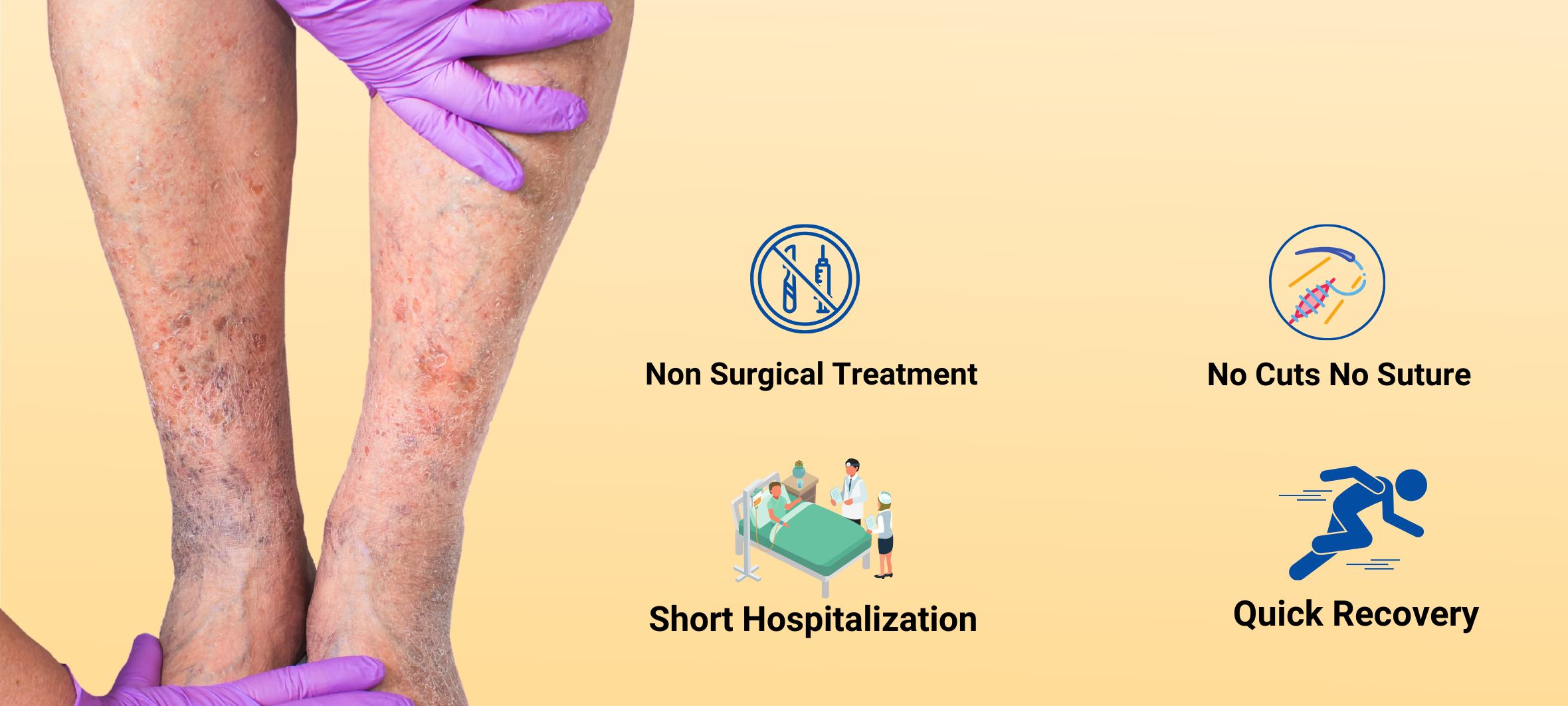 Varicose veins treatment in Bangalore