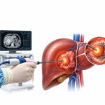 Ablation Therapy