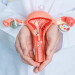 Uterine Fibroid Embolization